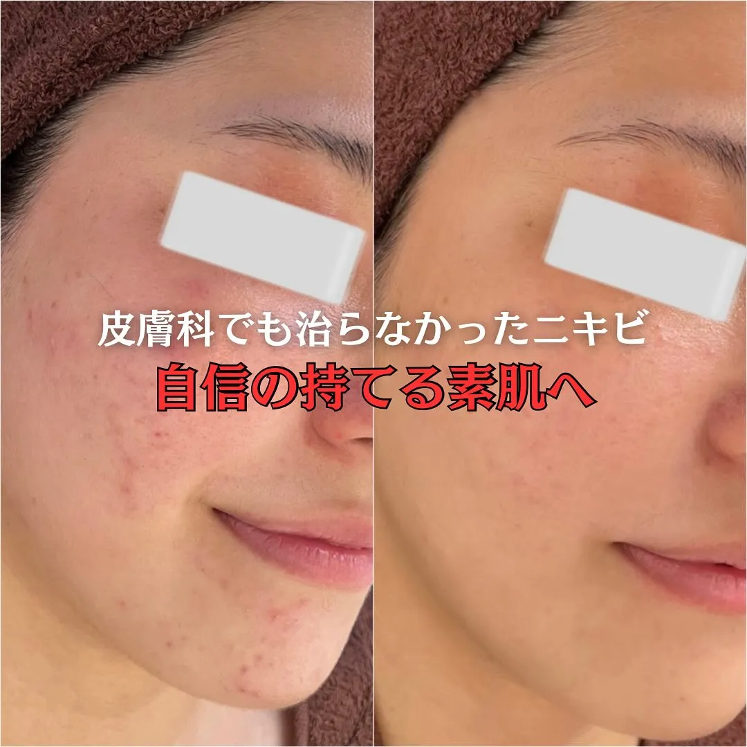 太田市にある頑固なニキビ専門店です✨️