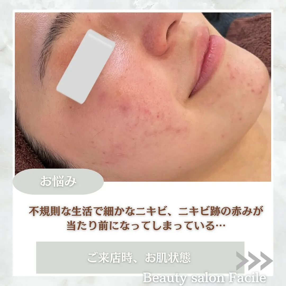 太田市にある頑固なニキビ専門店です✨️
