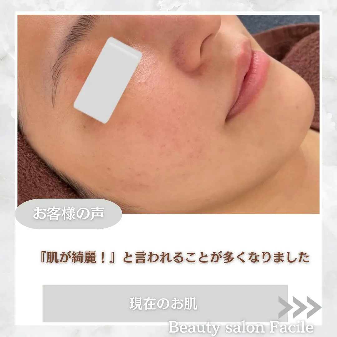 太田市にある頑固なニキビ専門店です✨️