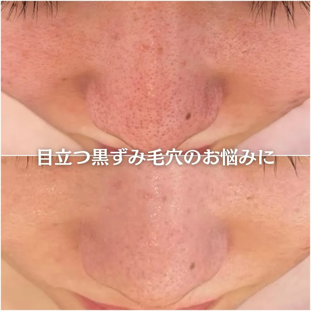 太田市にある頑固なニキビ専門店です✨️