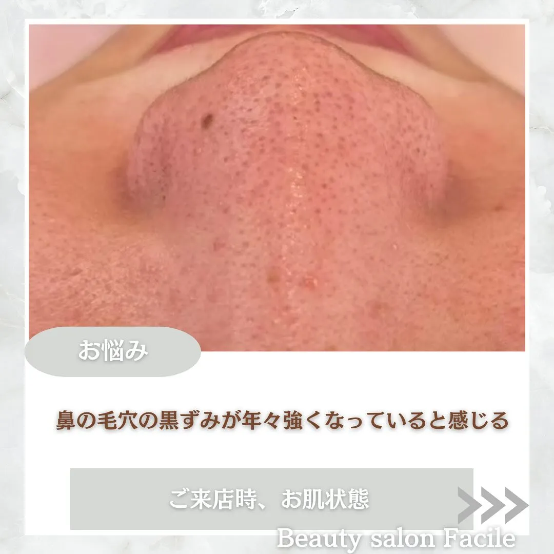 太田市にある頑固なニキビ専門店です✨️