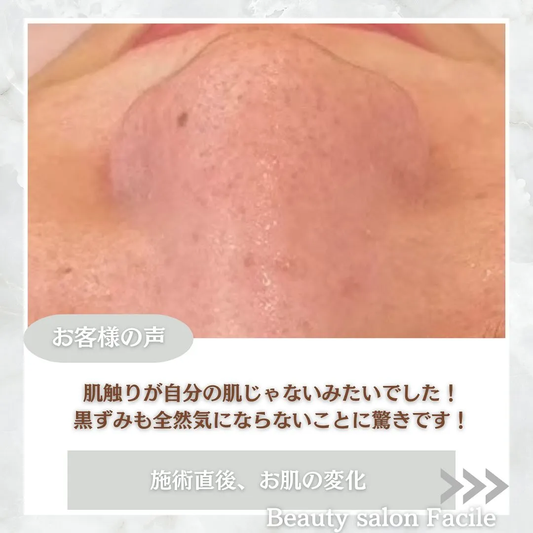 太田市にある頑固なニキビ専門店です✨️