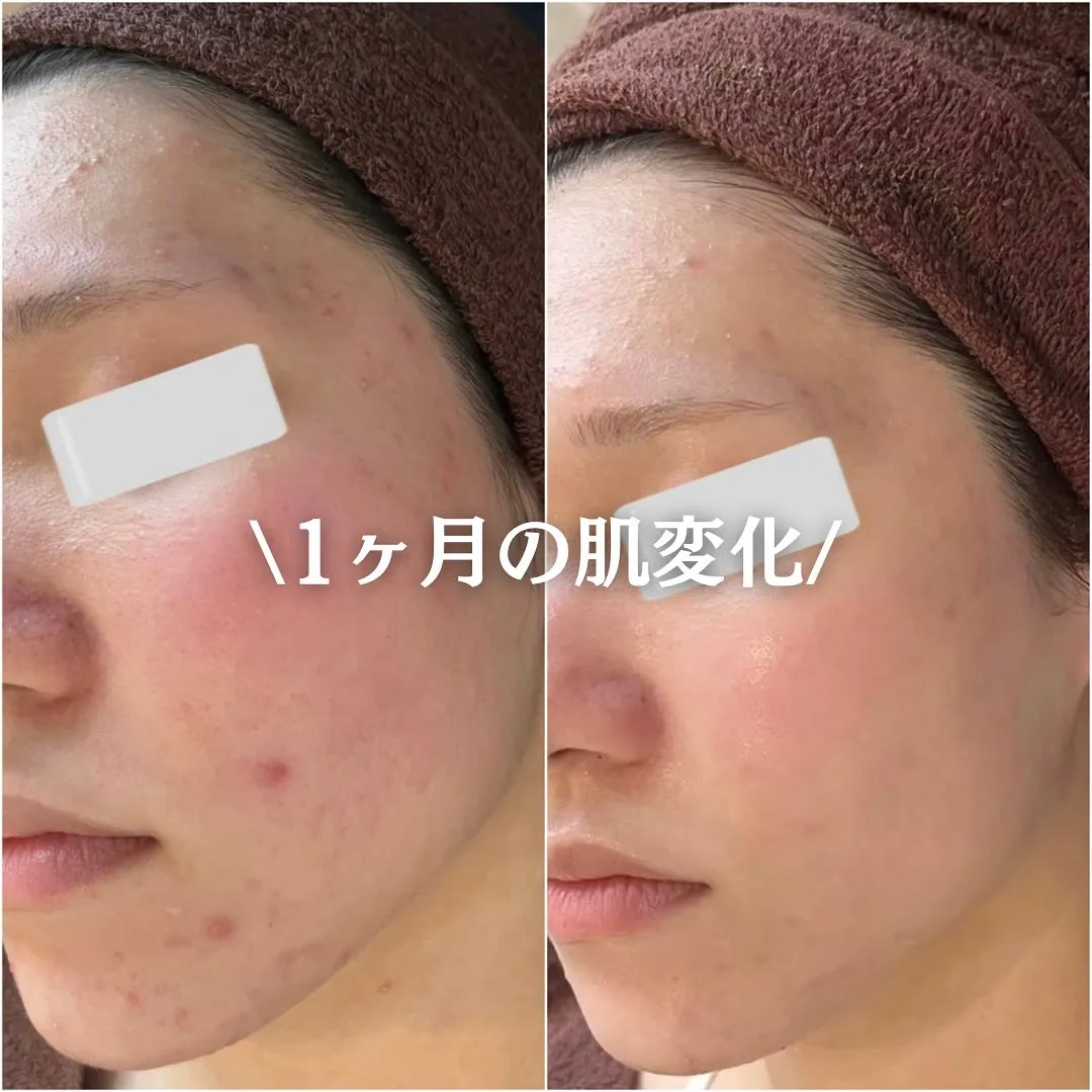 太田市にある頑固なニキビ専門店です✨️