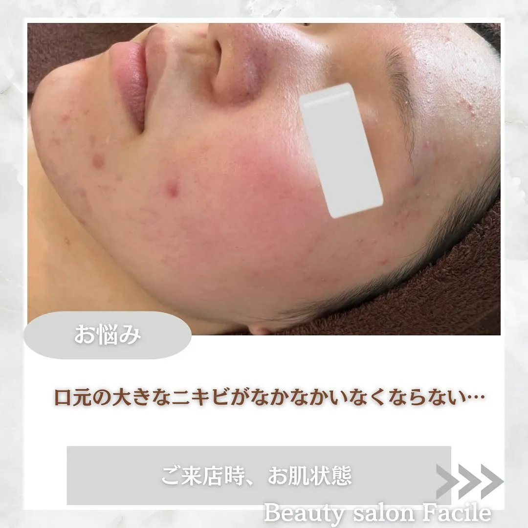 太田市にある頑固なニキビ専門店です✨️