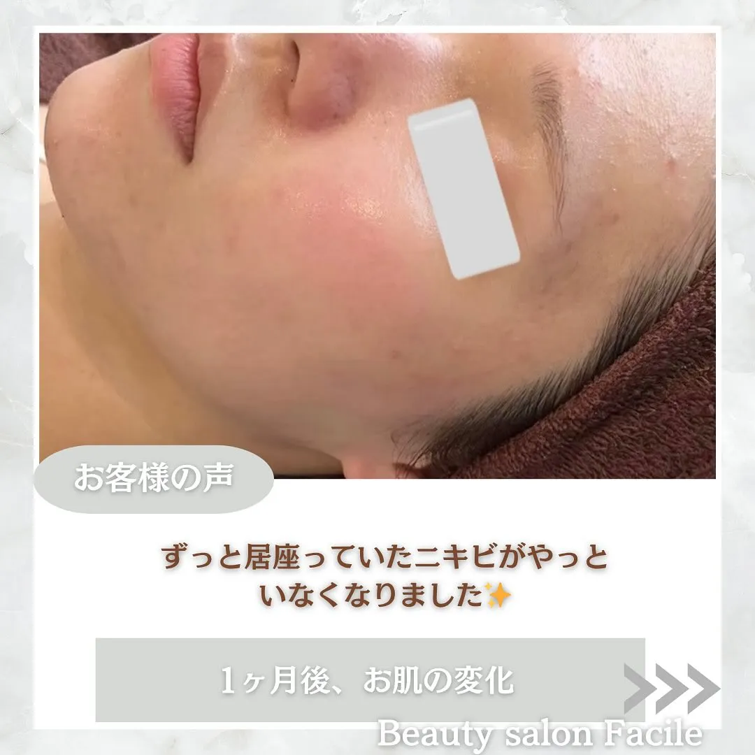 太田市にある頑固なニキビ専門店です✨️