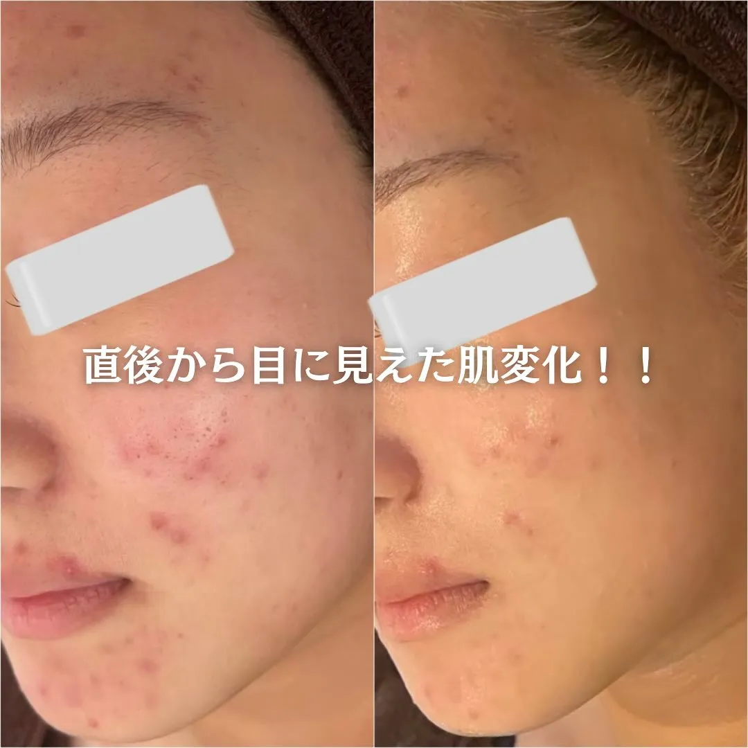 太田市にある頑固なニキビ専門店です✨️