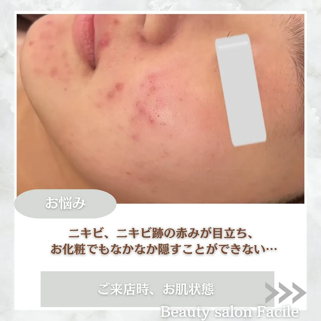 太田市にある頑固なニキビ専門店です✨️