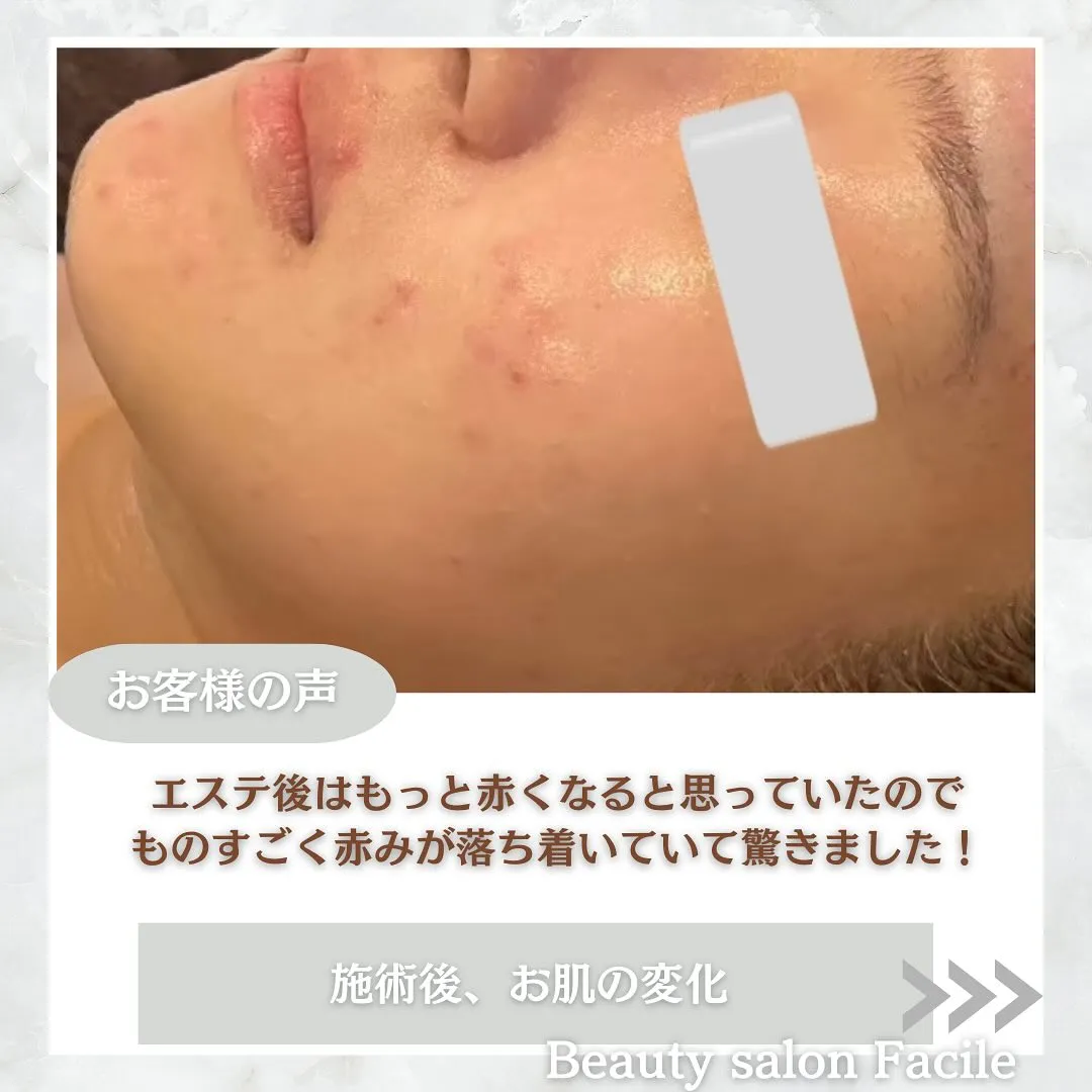 太田市にある頑固なニキビ専門店です✨️