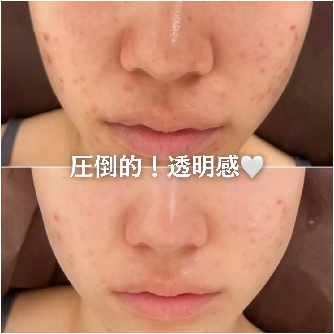 太田市にある頑固なニキビ専門店です✨️