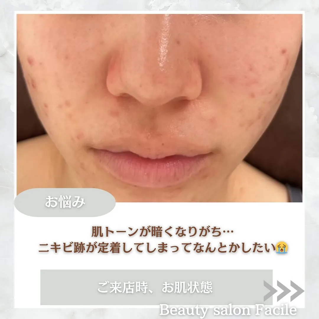 太田市にある頑固なニキビ専門店です✨️