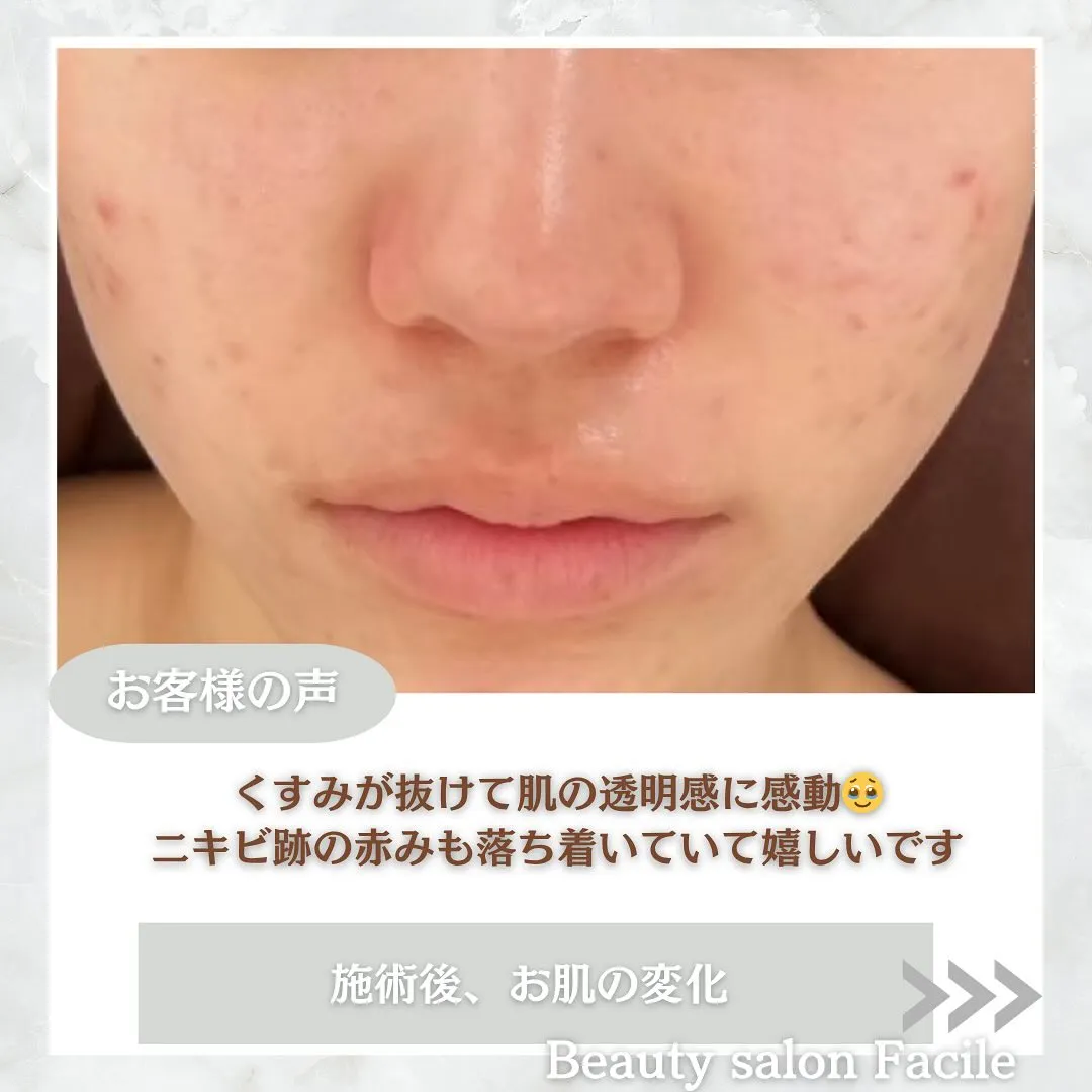 太田市にある頑固なニキビ専門店です✨️