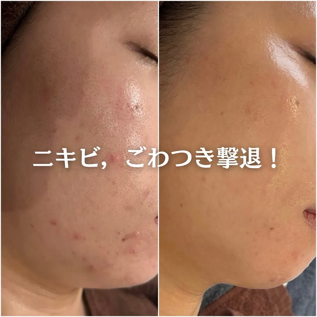 太田市にある頑固なニキビ専門店です✨️