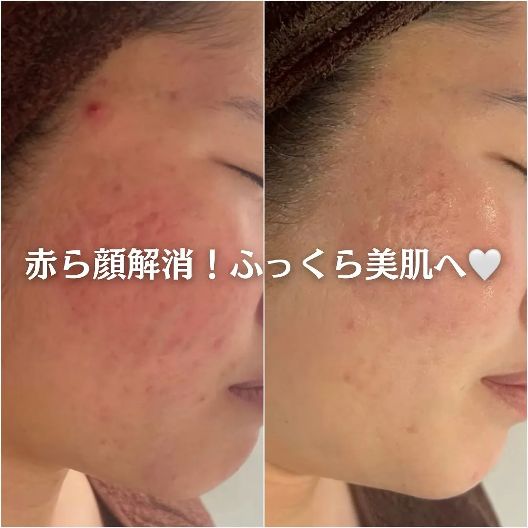 太田市にある頑固なニキビ専門店です✨️