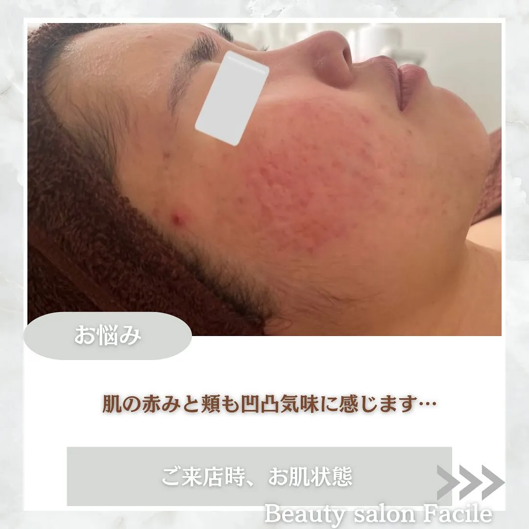 太田市にある頑固なニキビ専門店です✨️