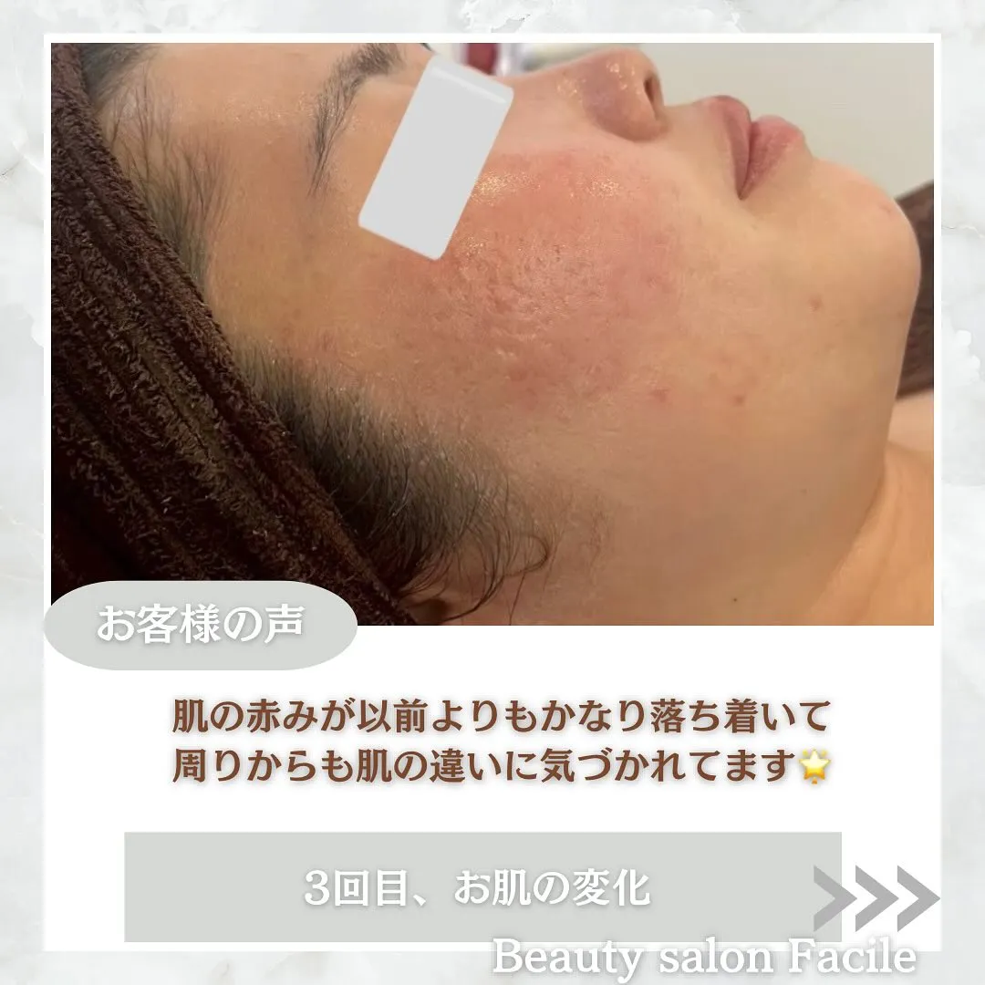 太田市にある頑固なニキビ専門店です✨️