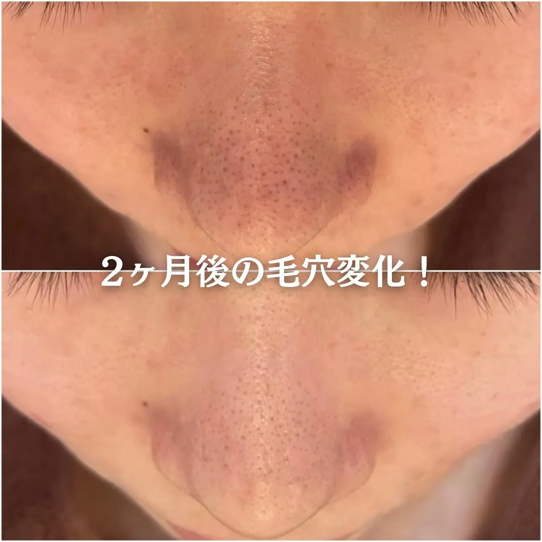 太田市にある頑固なニキビ専門店です✨️