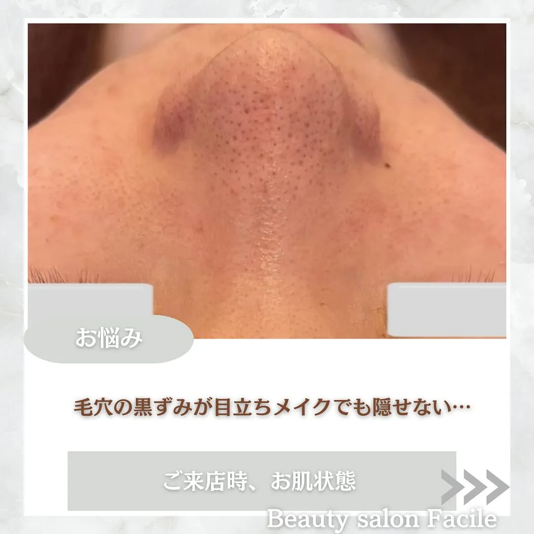 太田市にある頑固なニキビ専門店です✨️