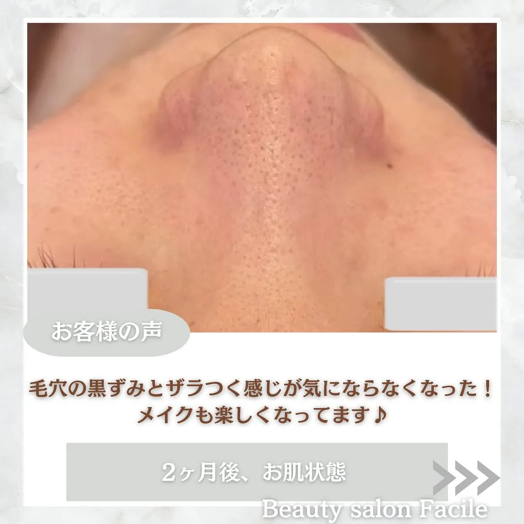 太田市にある頑固なニキビ専門店です✨️