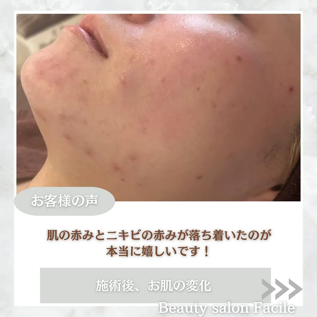 太田市にある頑固なニキビ専門店です✨️