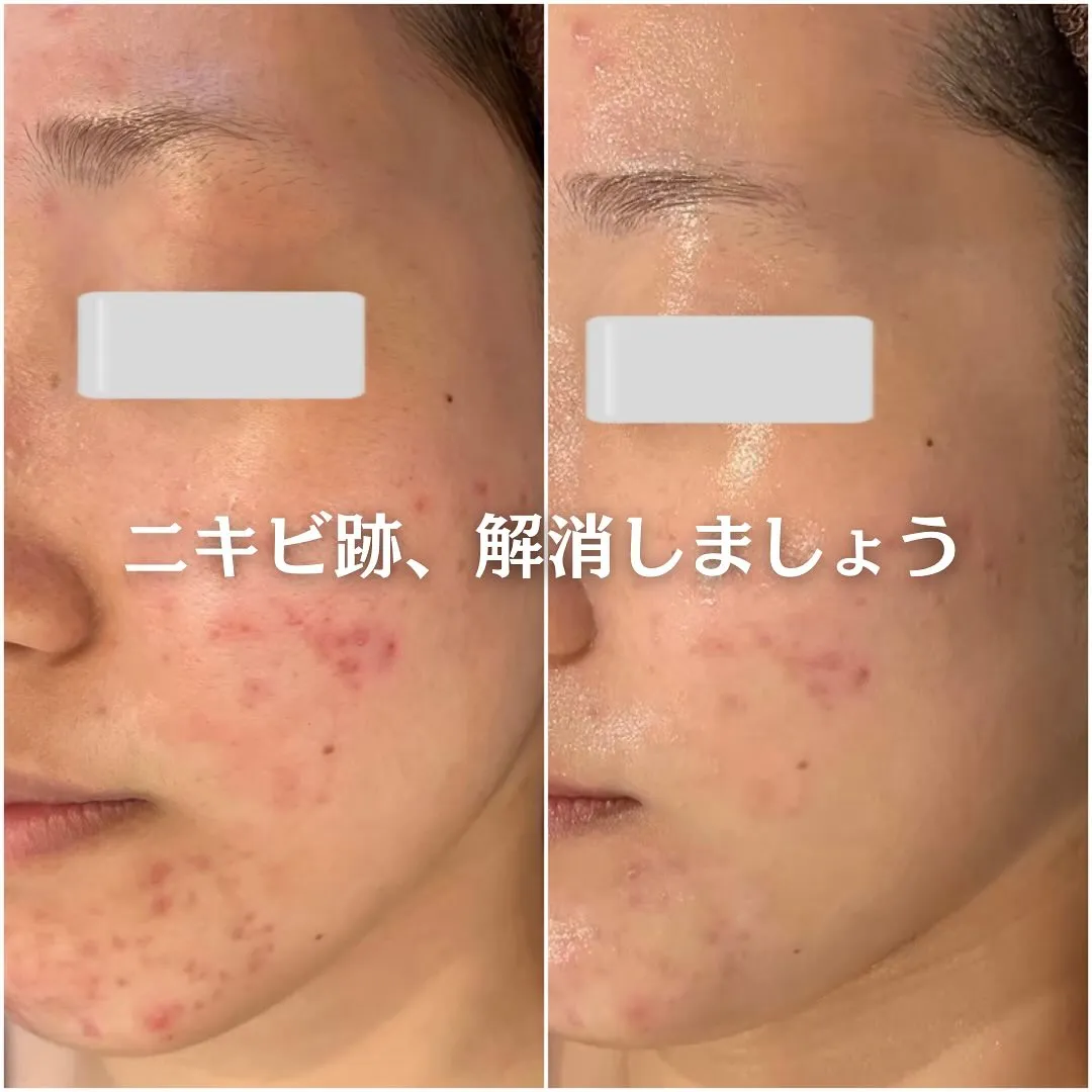 太田市にある頑固なニキビ専門店です✨️