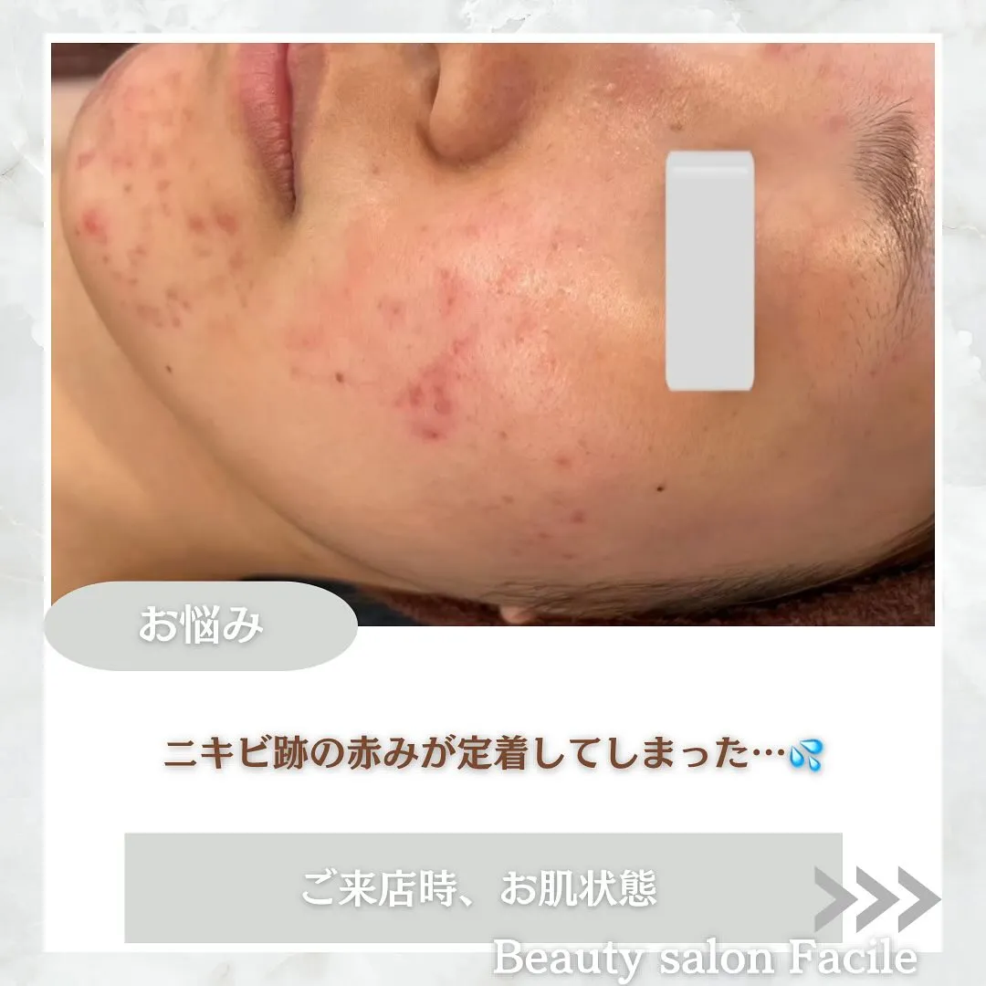 太田市にある頑固なニキビ専門店です✨️