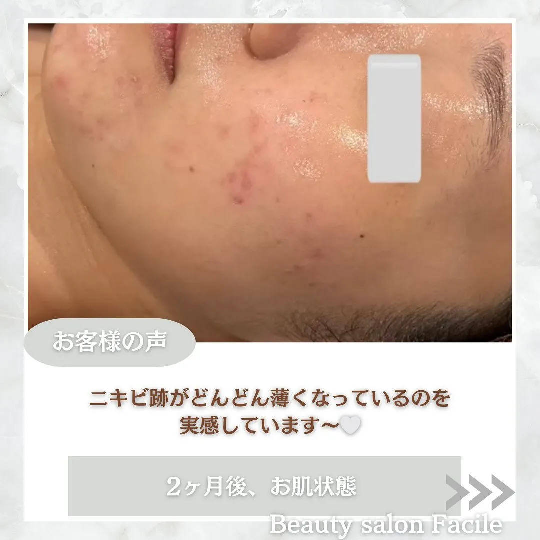 太田市にある頑固なニキビ専門店です✨️