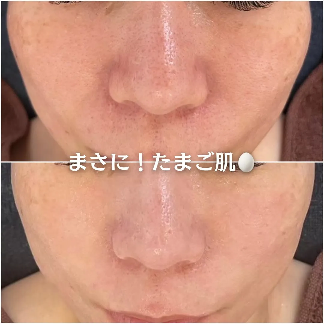 太田市にある頑固なニキビ専門店です✨️