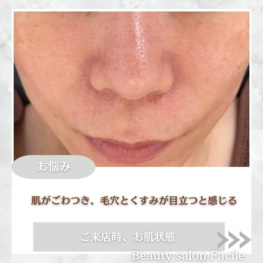 太田市にある頑固なニキビ専門店です✨️