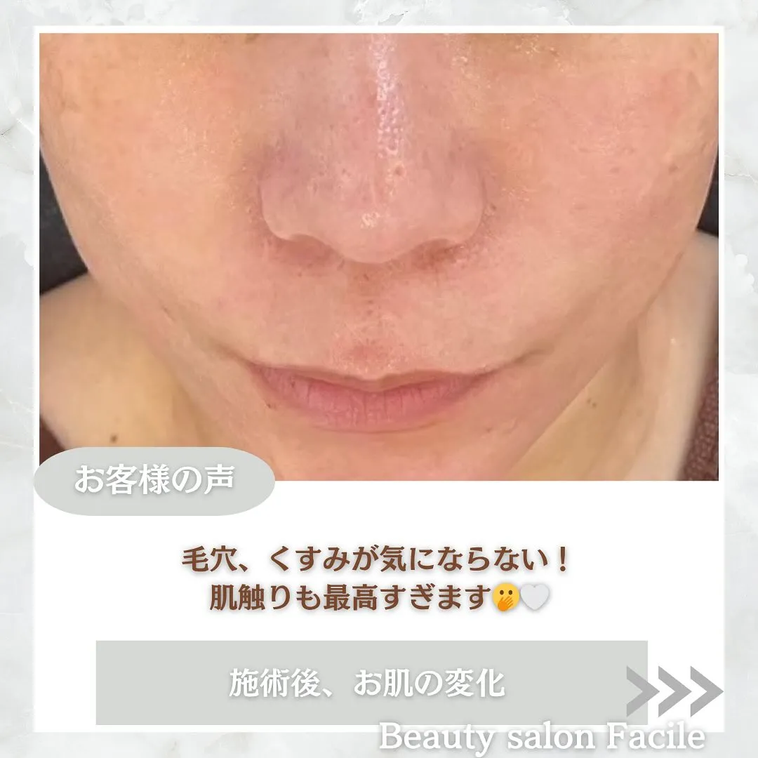 太田市にある頑固なニキビ専門店です✨️