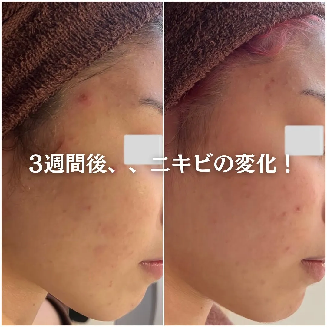 太田市にある頑固なニキビ専門店です✨️