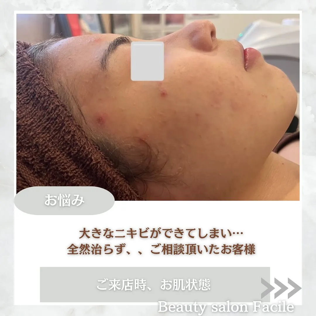 太田市にある頑固なニキビ専門店です✨️