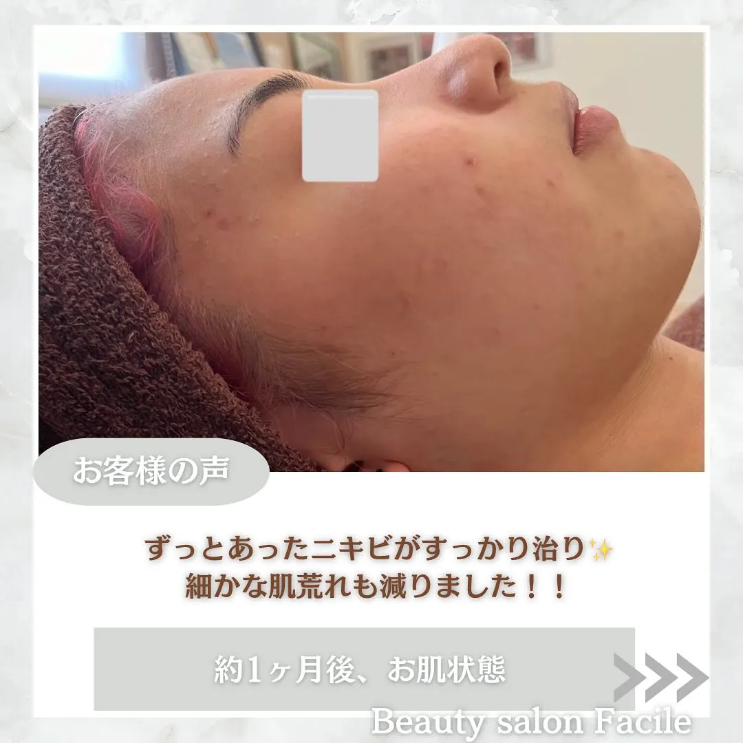 太田市にある頑固なニキビ専門店です✨️