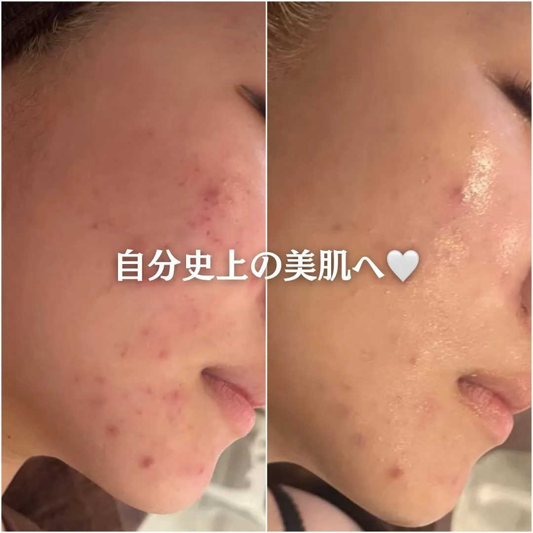 太田市にある頑固なニキビ専門店です✨️