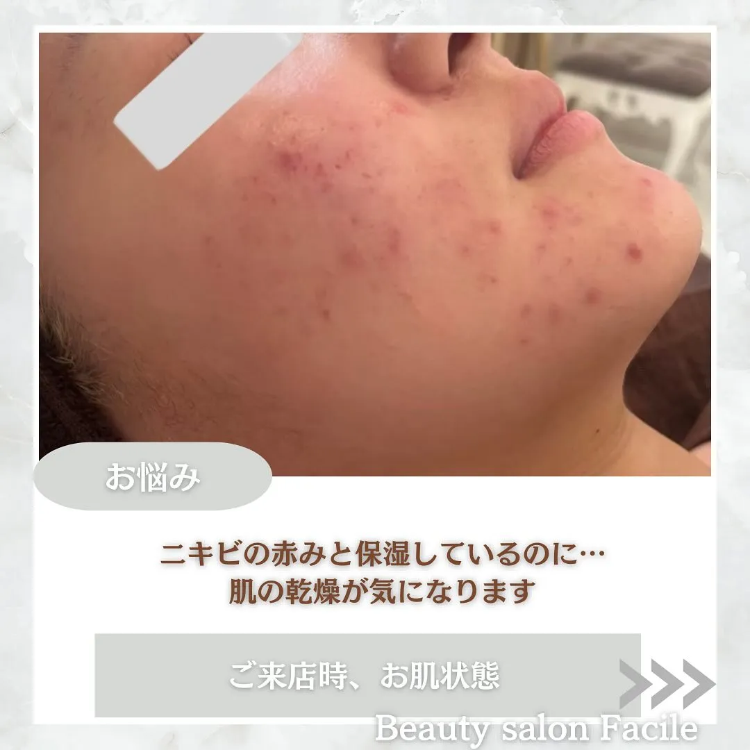 太田市にある頑固なニキビ専門店です✨️