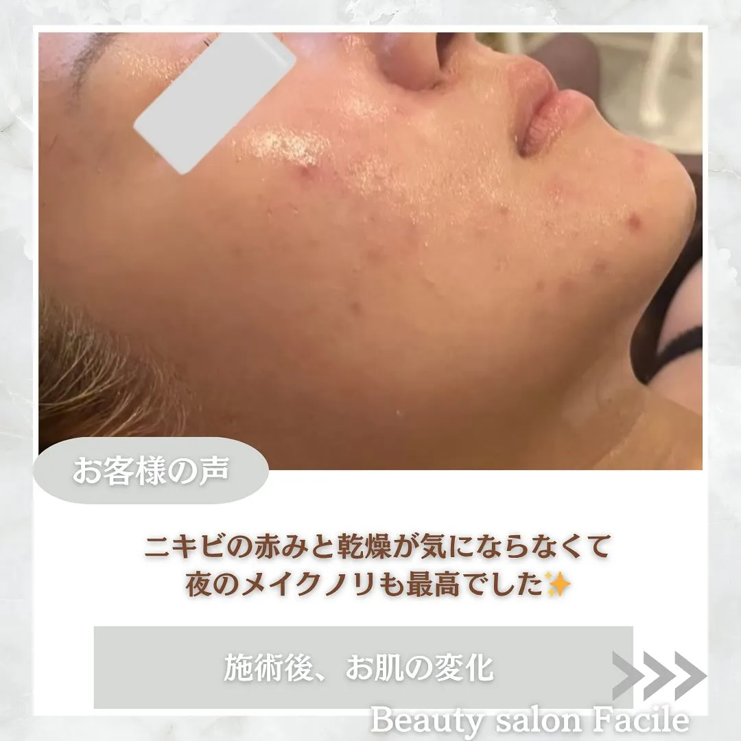 太田市にある頑固なニキビ専門店です✨️