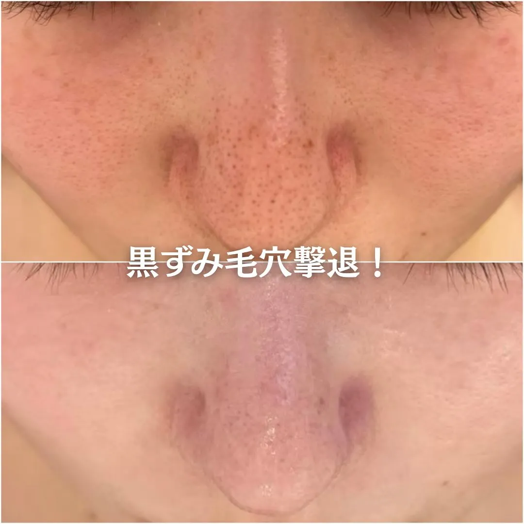 太田市にある頑固なニキビ専門店です✨️