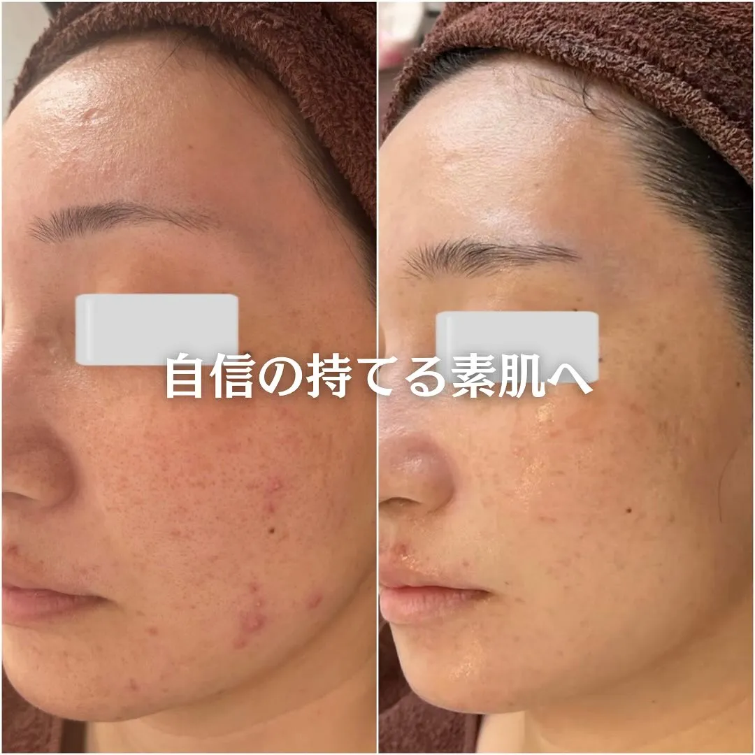 太田市にある頑固なニキビ専門店です✨️