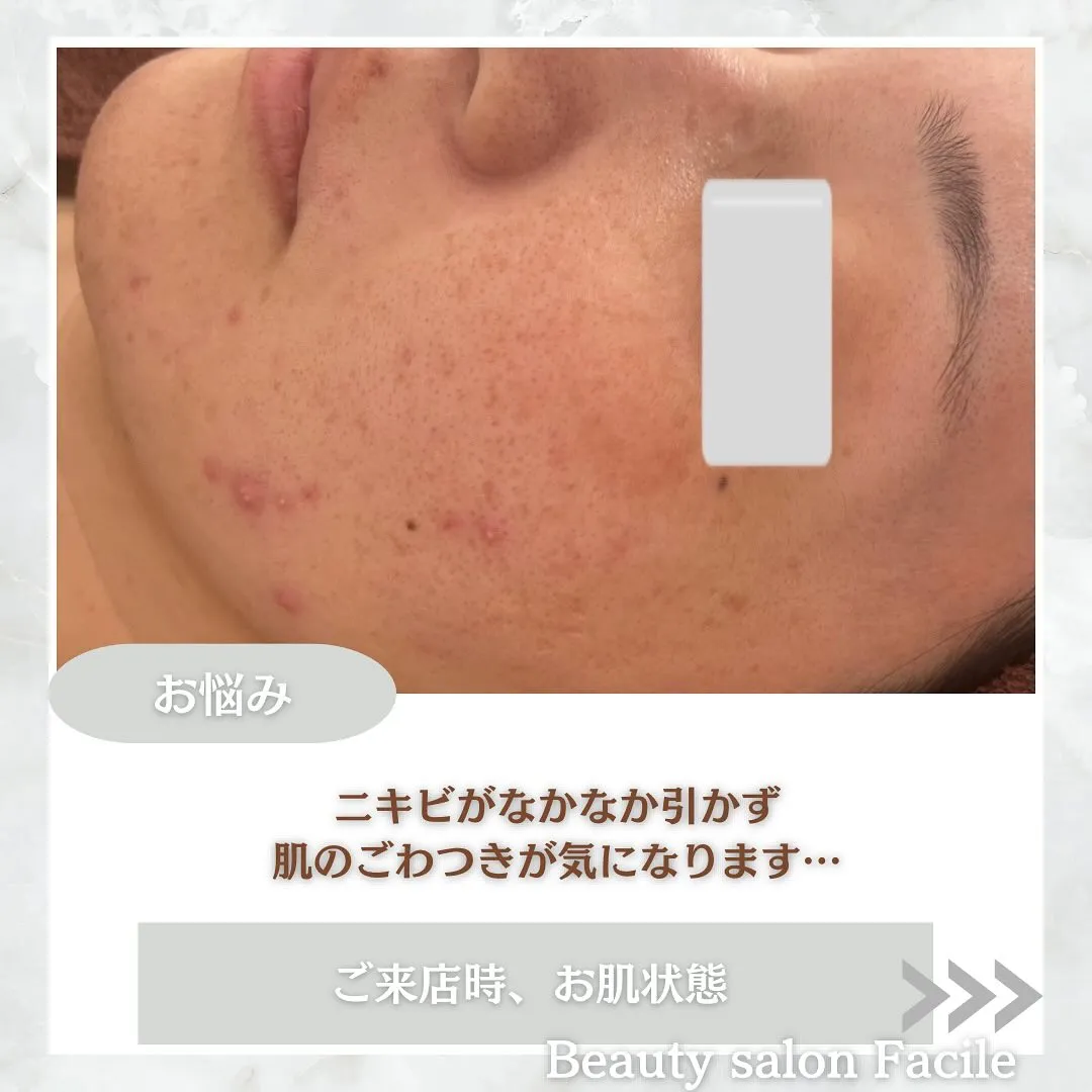 太田市にある頑固なニキビ専門店です✨️