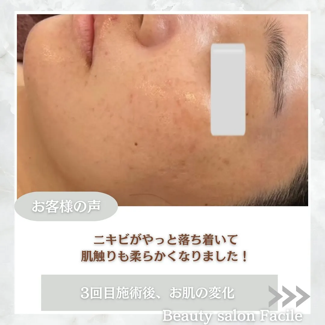 太田市にある頑固なニキビ専門店です✨️