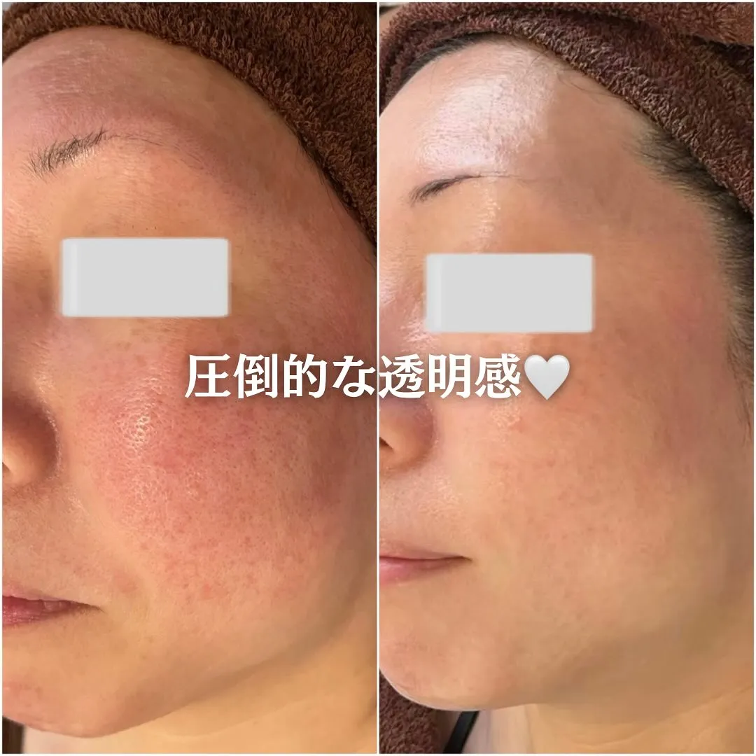 太田市にある頑固なニキビ専門店です✨️