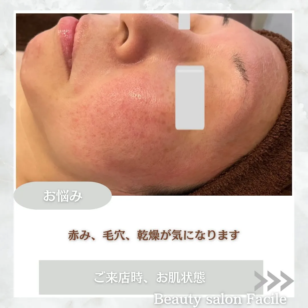 太田市にある頑固なニキビ専門店です✨️