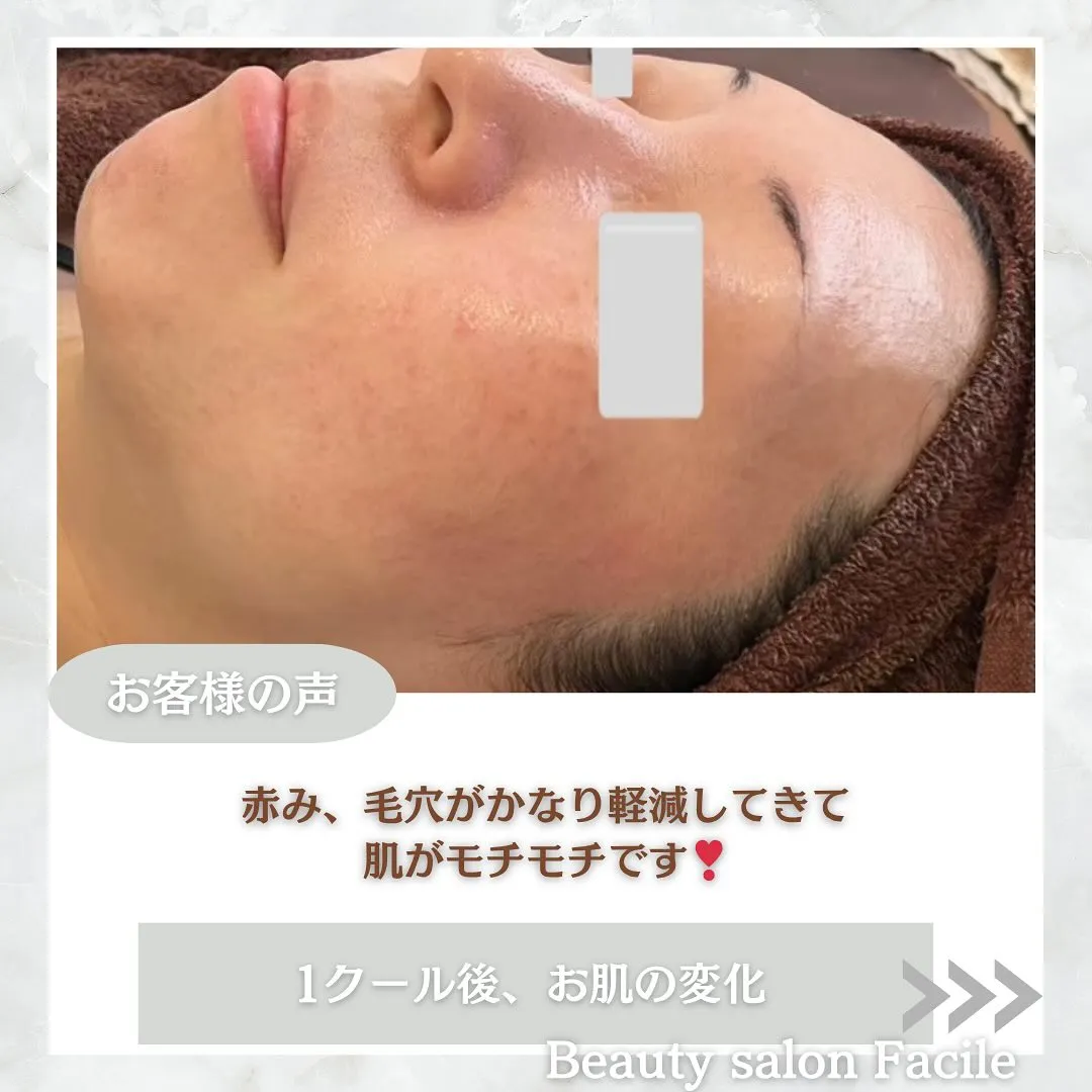 太田市にある頑固なニキビ専門店です✨️