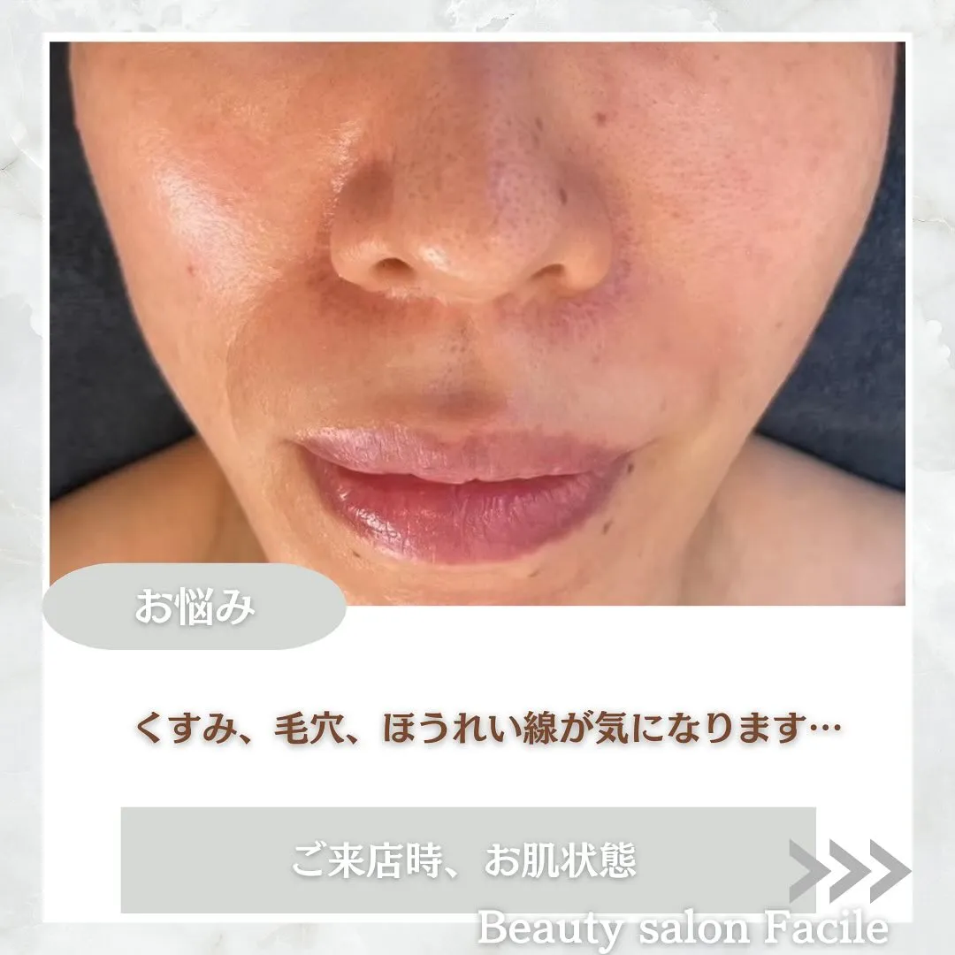 太田市にある頑固なニキビ専門店です✨️