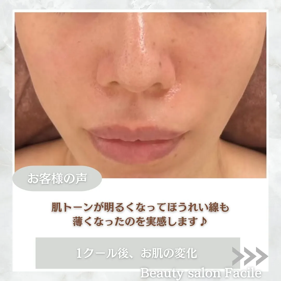 太田市にある頑固なニキビ専門店です✨️