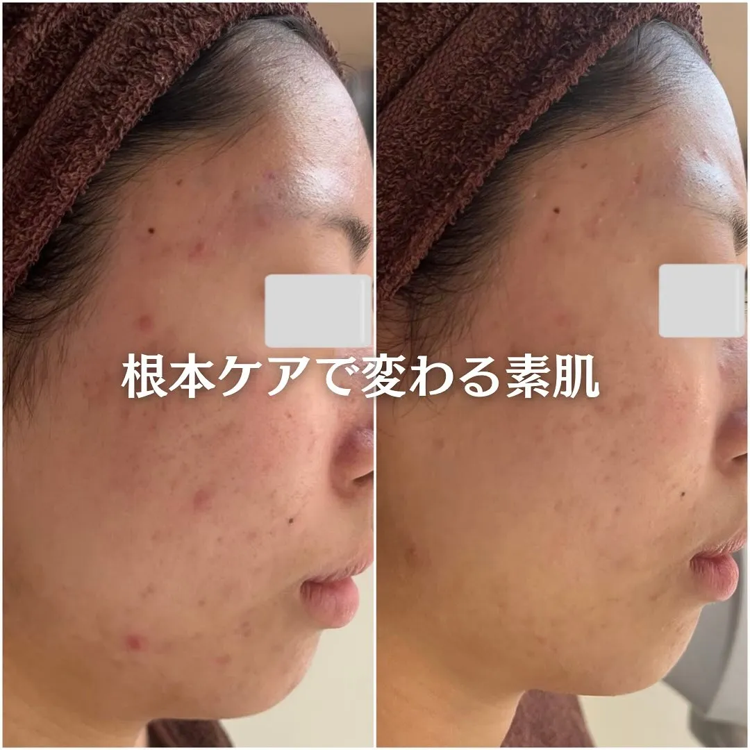 太田市にある頑固なニキビ専門店です✨️