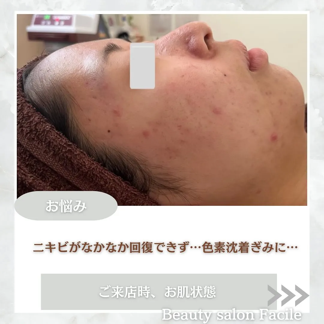 太田市にある頑固なニキビ専門店です✨️