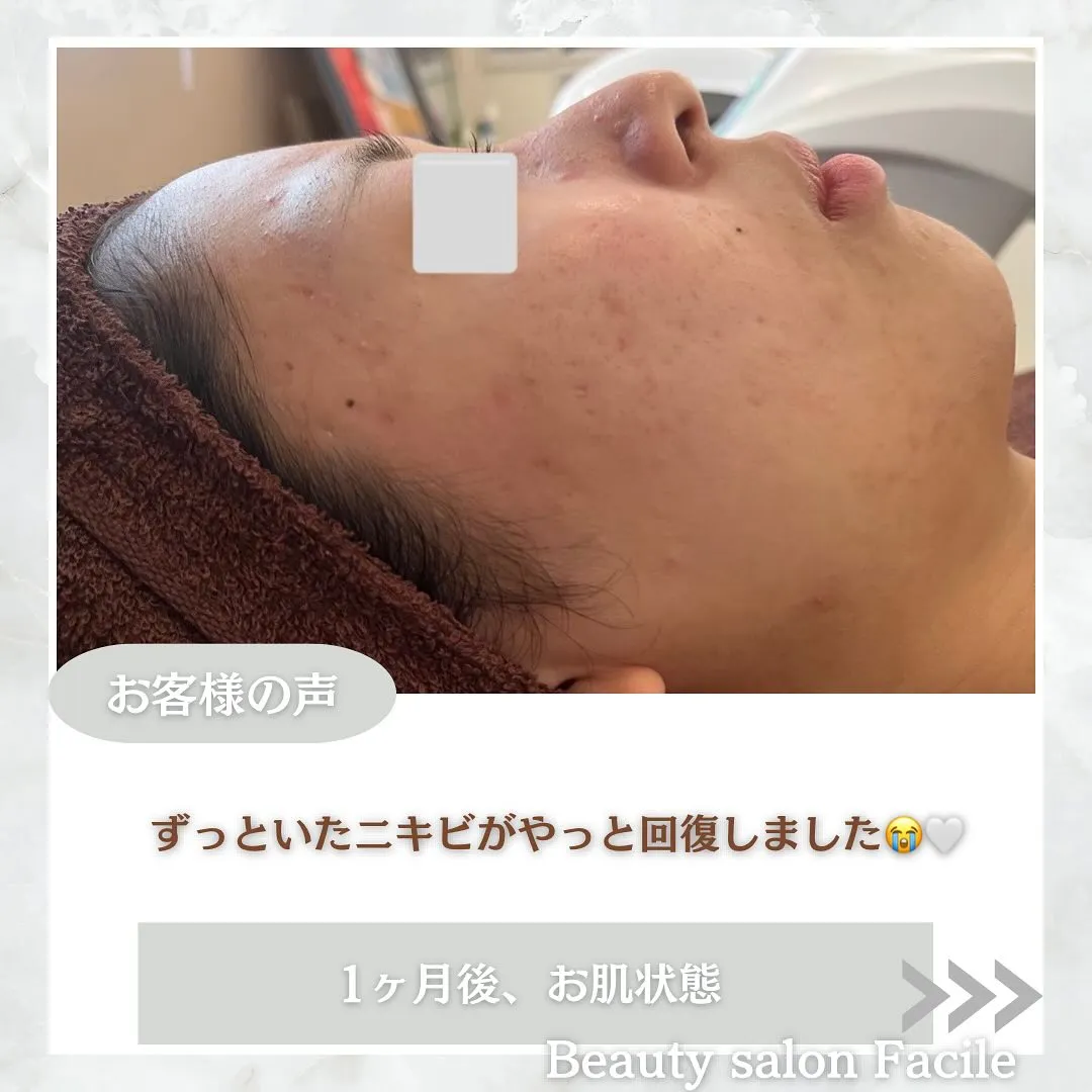 太田市にある頑固なニキビ専門店です✨️