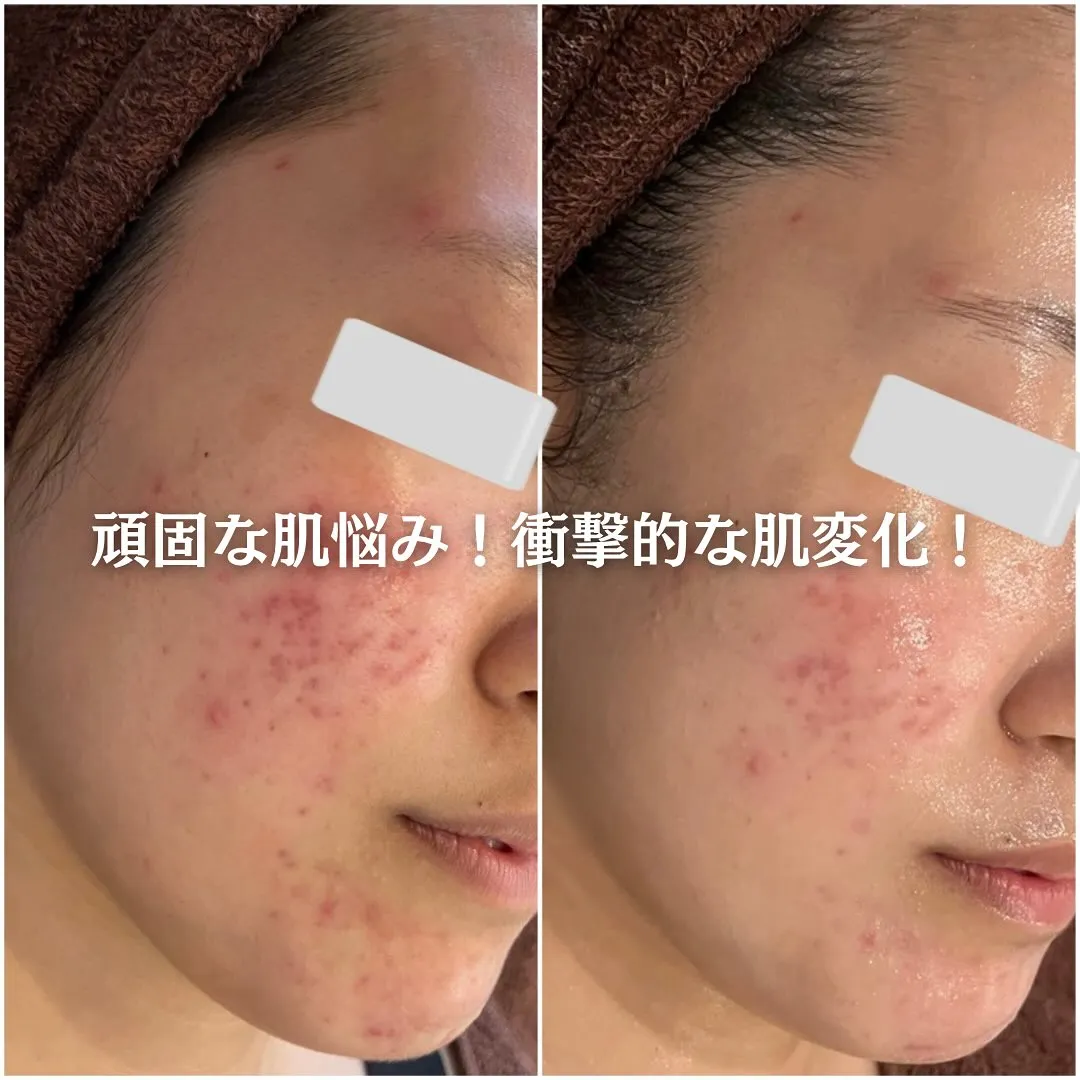 太田市にある頑固なニキビ専門店です✨️