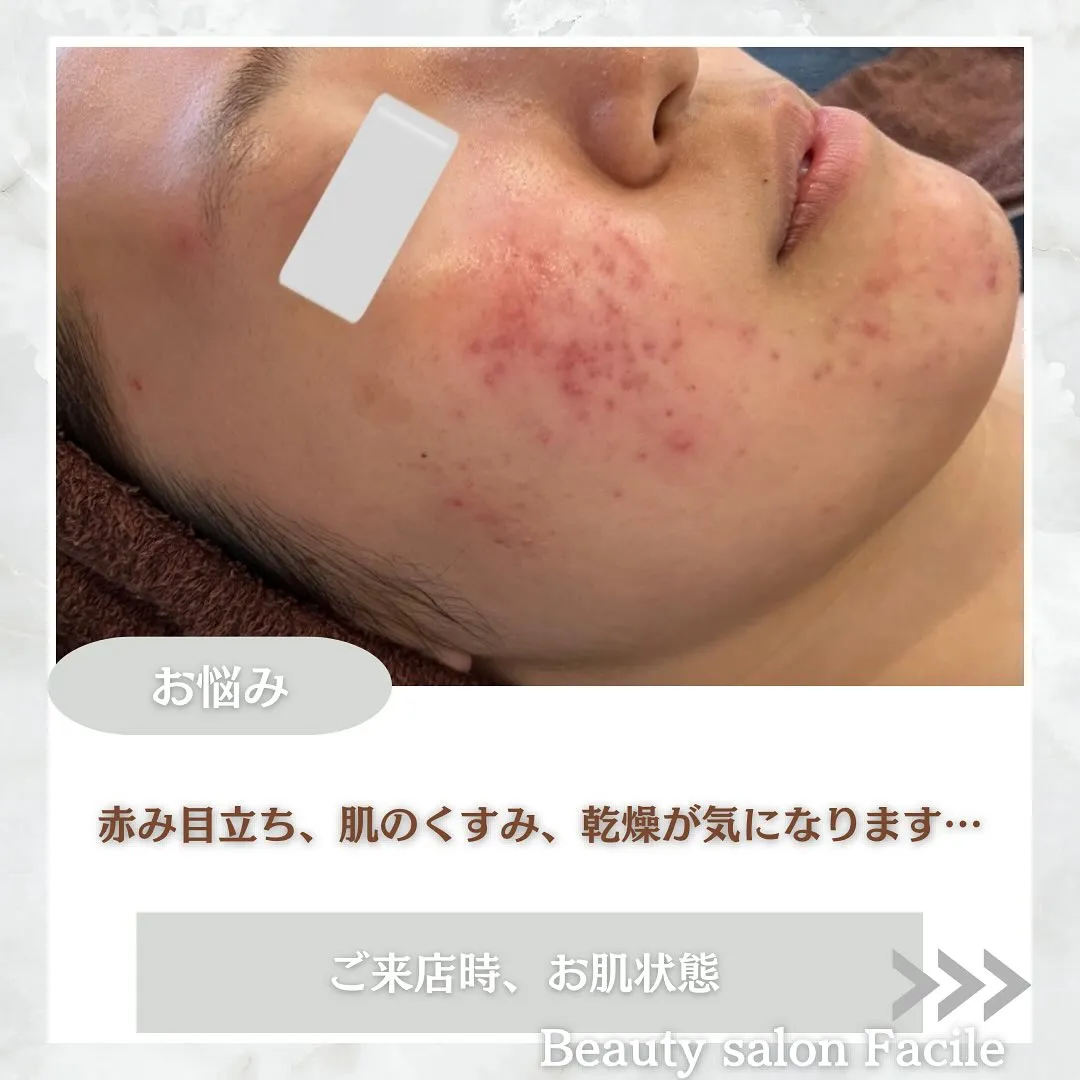 太田市にある頑固なニキビ専門店です✨️