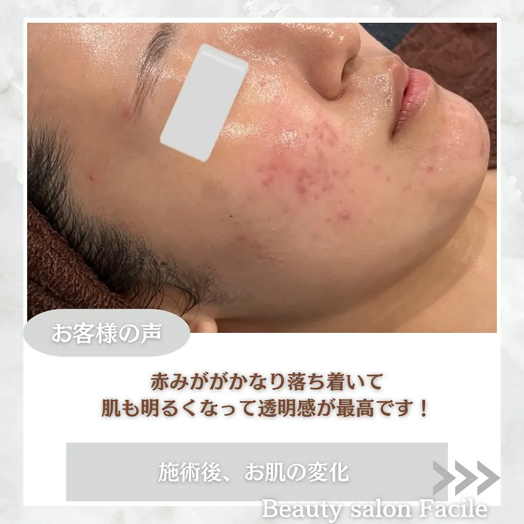 太田市にある頑固なニキビ専門店です✨️